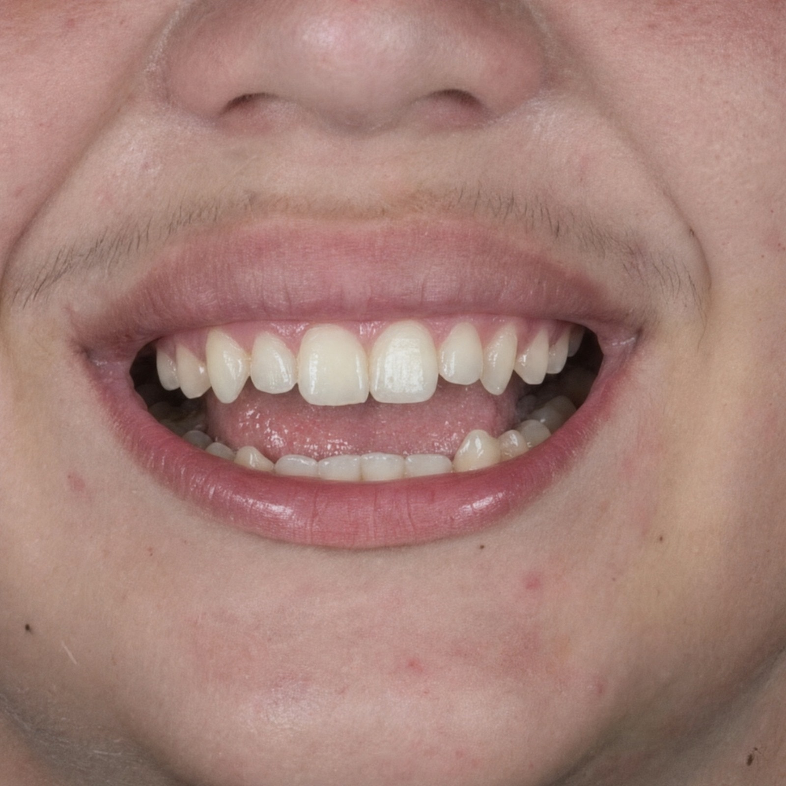 Sonrisa joven, resultado natural · Antes del tratamiento