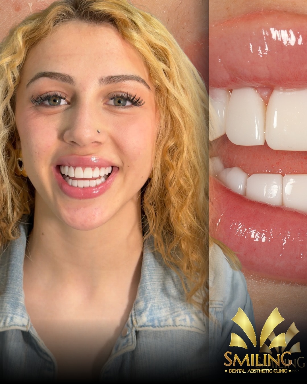 Paciente de Smiling tras su diseño de sonrisa