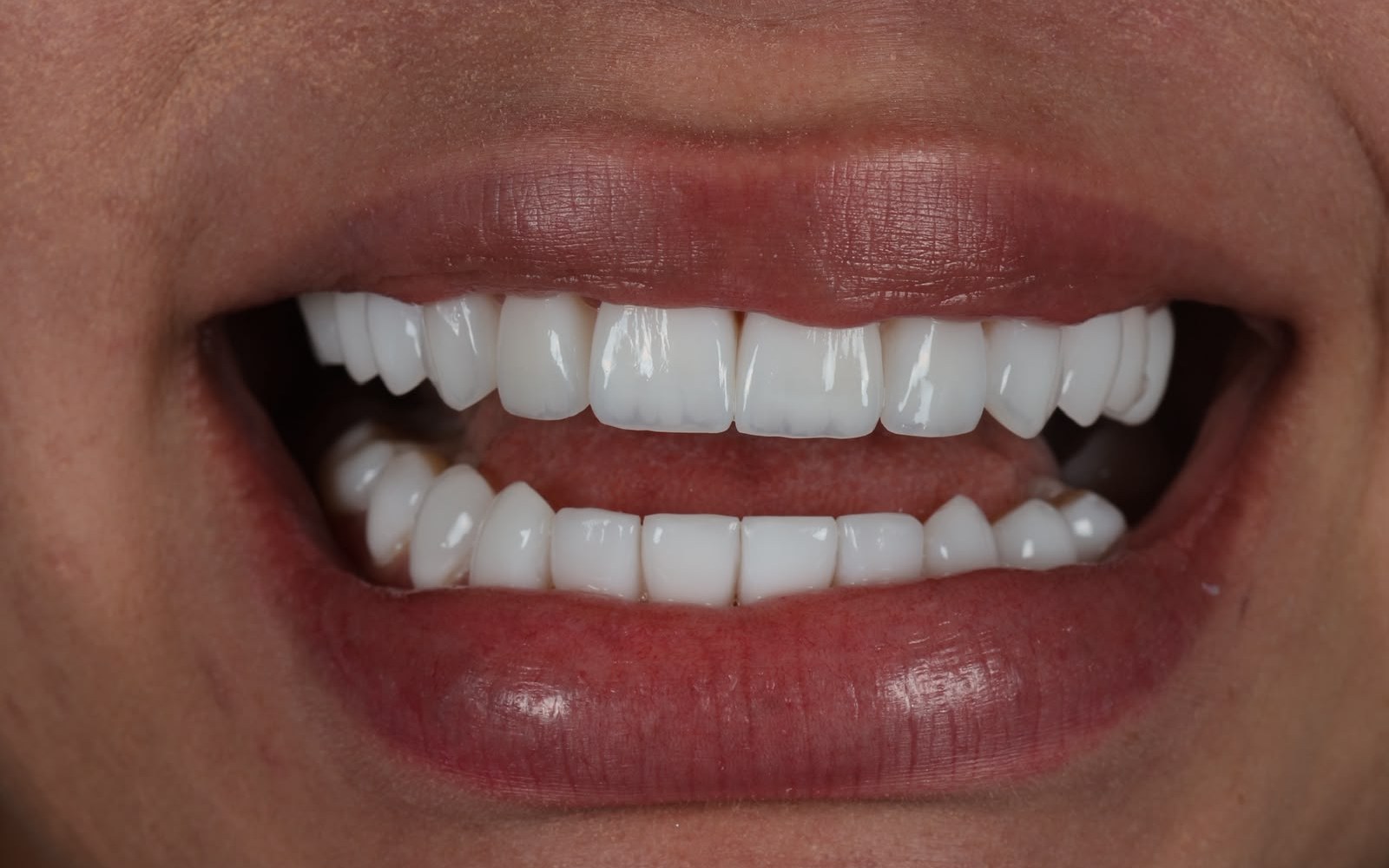Composite impreso 3D · caso de Smiling