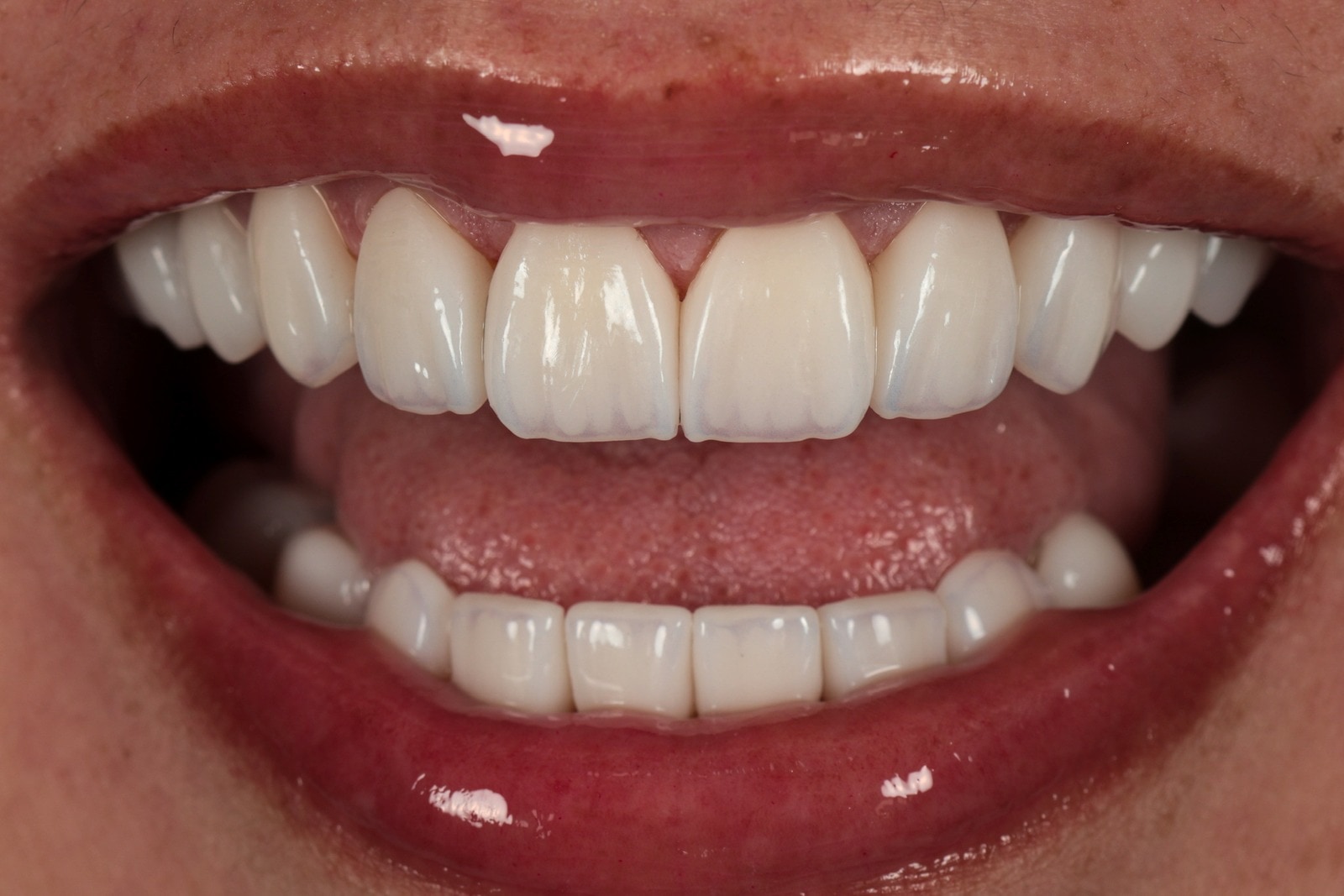 Cerámica E-max · caso de Smiling