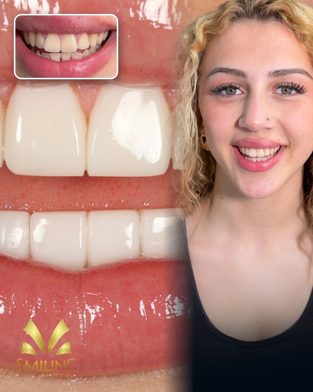 Paciente de Smiling con su nueva sonrisa